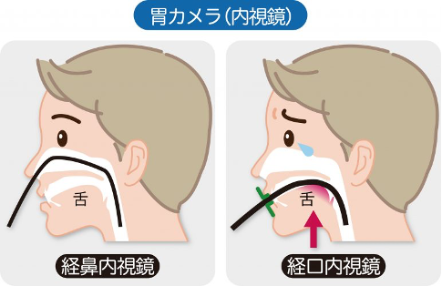 経鼻検査